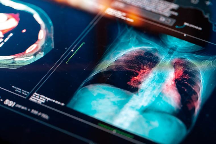 New figures show thousands of people not getting timely access to cancer care, TD says